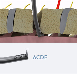 ACDF