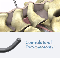 Contralateral Foraminotomy