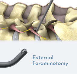 External Foraminotomy