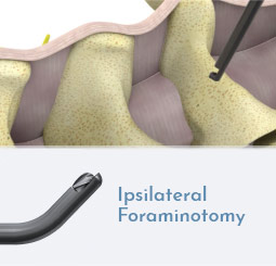 Ipsilateral Foraminotomy