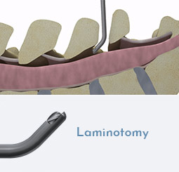 Laminotomy