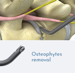 Osteophytes removal