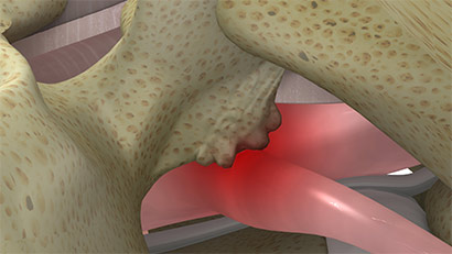 Hypertrophic SAP neural impingement within foramen