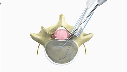 Complete intervertebral access for endplate prep