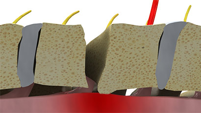 Dorsal osteophyte impingement during Anterior Cervical